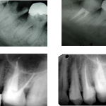 RX antes y después de endodoncia