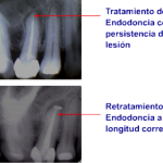 Retratamiento de endodoncia